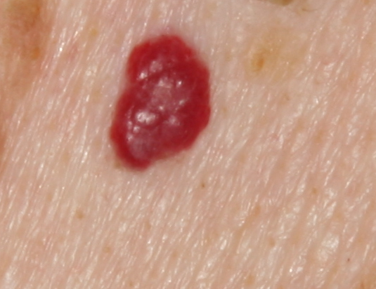 Squamous Cell Carcinoma Picture Image on MedicineNet.com