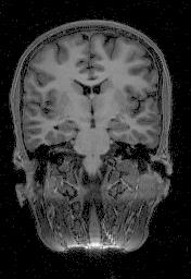 mri image of a brain