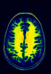 mri image of a brain