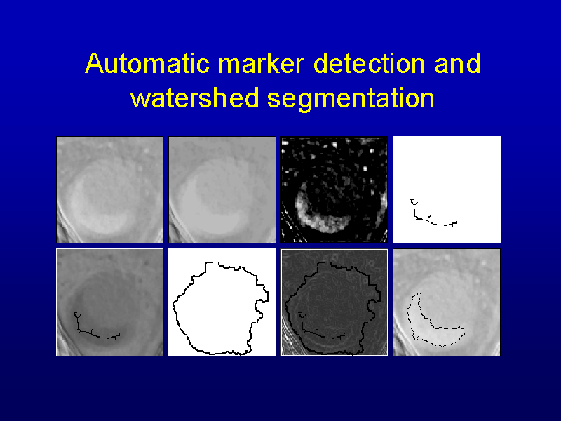 Automatic marker detection and watershed segmentation