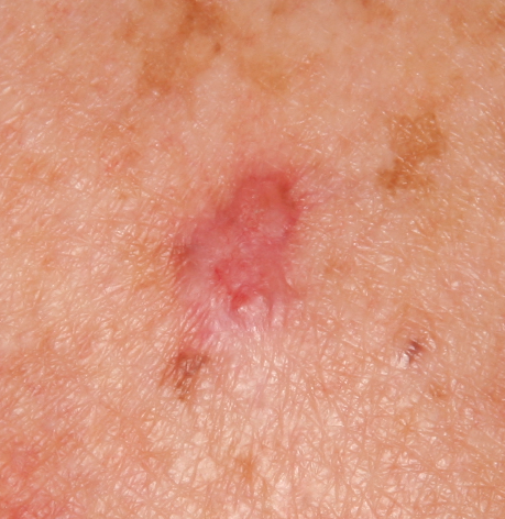 benign skin lesions