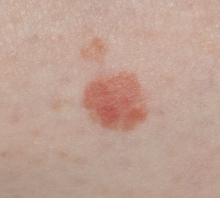 pre cancer skin spots