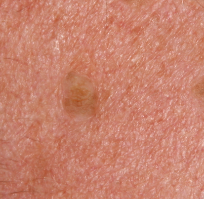 Skin Lesion Chart